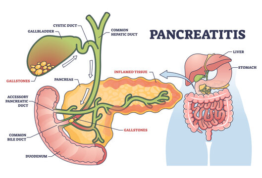 Pancreatitis as pancreas inflammation from chronic or acute gallstones outline diagram, transparent background. Labeled educational medical scheme.