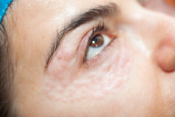 Fototapeta premium Female patient receiving a mesotherapy hydration procedure on eyelids with microneedles at dermatologist office.