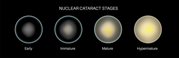 Cataract eye disease