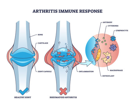 Arthritis immune response with rheumatoid bone disease outline diagram, transparent background. Labeled educational medical condition with painful joints and inflammation illustration.