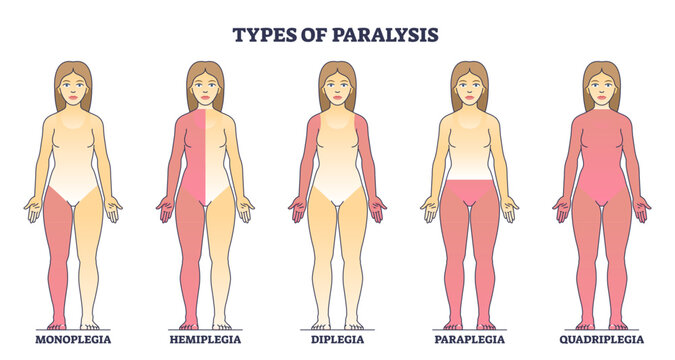 Types of paralysis and limb body parts as medical condition outline diagram, transparent background. Labeled educational scheme with monoplegia, hemiplegia.
