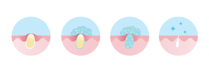 Process of acne pimple treatment vector icon set illustration. Apply salicylic acid on whitehead, penetrate into skin to dissolve closed plugged pore the dead skin cell, sebum and keeping pore clear.