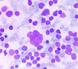 Bone marrow study smear picture of Acute Myeloid Leukemia, Blast cell, Granulopoiesis. Hematology. Blood cancer.