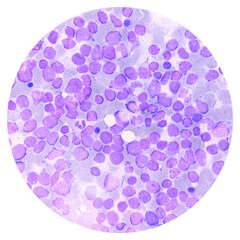 Bone marrow study smear picture of Acute Myeloid Leukemia, Blast cell, Granulopoiesis. Hematology....