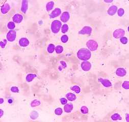 Bone marrow study smear picture of Acute Myeloid Leukemia, Blast cell, Granulopoiesis. Hematology....