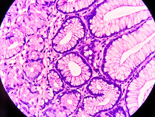 Photomicrograph of stomach biopsy showing Hyperplastic polyp.
