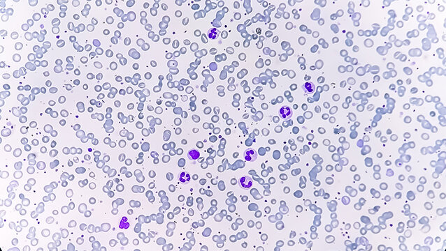 Anisocytosis anisochromia with both microcytic hypochromic and macrocytic hypochromic RBC with rouleaux formation, Dimorphic anemia. 