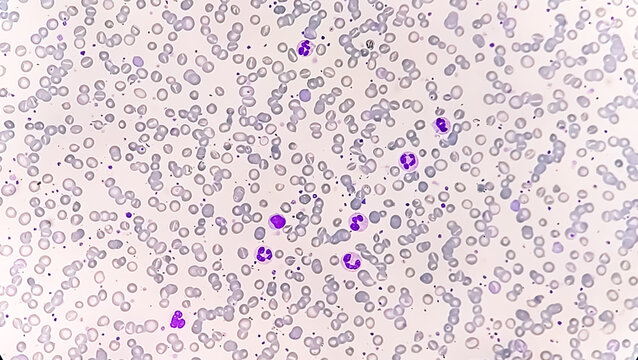 Anisocytosis anisochromia with both microcytic hypochromic and macrocytic hypochromic RBC with rouleaux formation, Dimorphic anemia. 