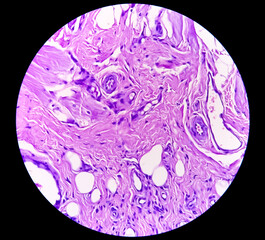 Microscopic examination showing Leukoplakia, buccal mucosa leukoplakia