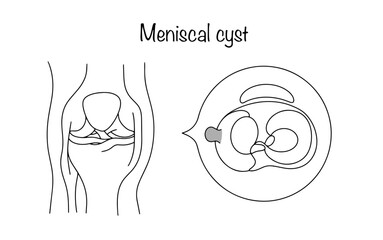 Meniscal cyst