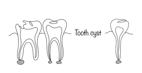 Tooth cyst