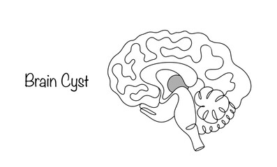 Brain Cyst