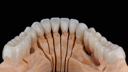 model of the upper jaw with crowns for total prosthetics, view from inside © Dental Pro Content