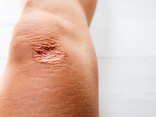 Fototapeta premium Close-up of scars on knee skin imperfections or defects caused by an accident scar healthcare concept