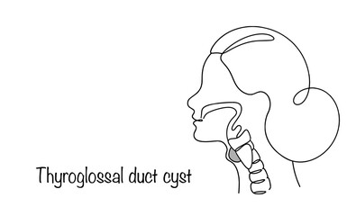 Thyroglossal Duct Cyst