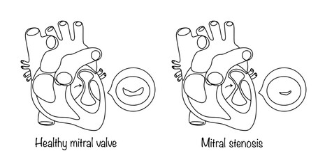 Mitral stenosis