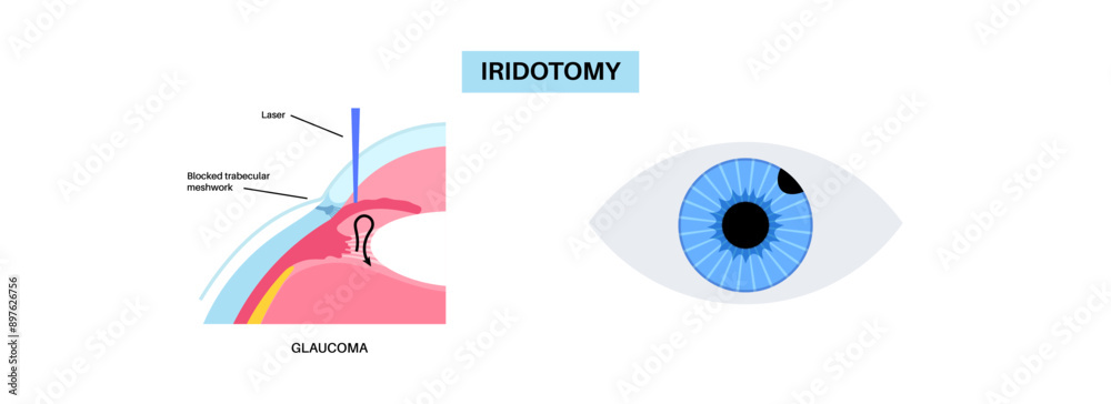 Poster Iridectomy medical poster