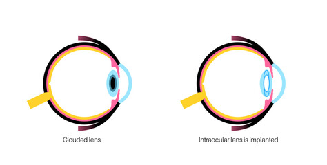 Intraocular lenses poster