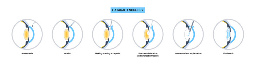 Cataract surgery poster