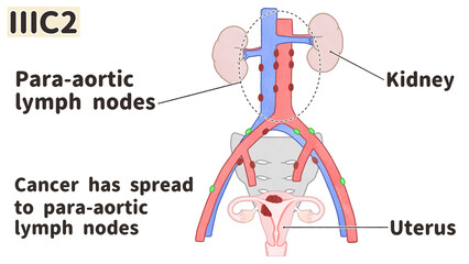 Endometrial cancer (Uterine cancer) Stage 3C2 diagram PNG