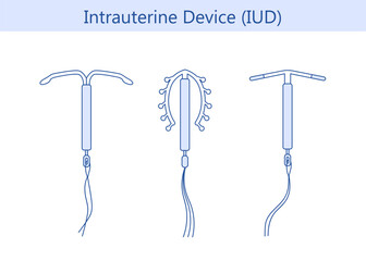 Intrauterine device or IUD.  intrauterine contraceptive device.  Vector illustration