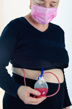Navigating Post-Surgery Recovery: The Role of Drainage Systems in Managing Lymphatic Fluid