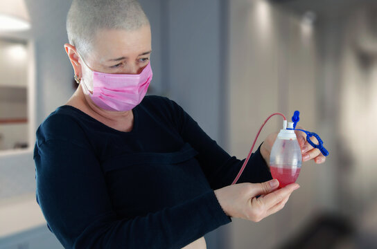 A cancer patient with a shaved head examines the drainage fluid color post-mastectomy, noting the reddish hue typical in early recovery stages.