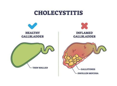 Cholecystitis as inflamed gallbladder compared with healthy outline diagram, transparent background. Labeled educational scheme with swollen mucosa and gallstones in digestive tract illustration.