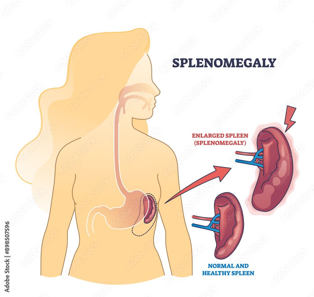 Wall mural Splenomegaly symptom as enlarged spleen vs healthy organ outline diagram, transparent background. Labeled educational scheme.