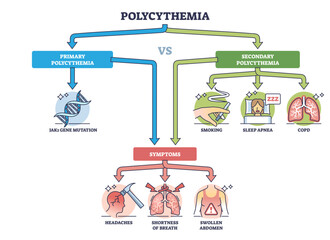 Polycythemia or erythrocytosis as red cells overproduction and increased blood mass outline diagram, transparent background. Labeled educational scheme with primary.