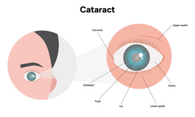 Cataract eye anatomy problem disease 