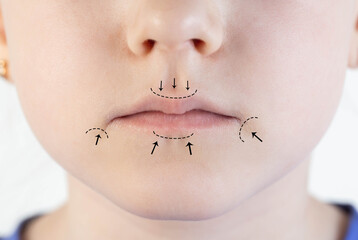 Black marks on a girl s lips before lip contouring. Laser plastic surgery of lip shape and volume,...