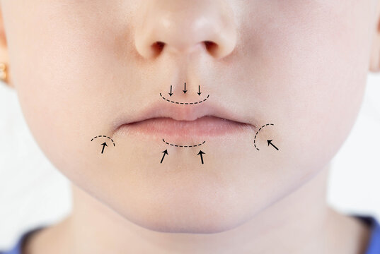 Black marks on a girl s lips before lip contouring. Laser plastic surgery of lip shape and volume, correction of lip frenulum in children, close-up