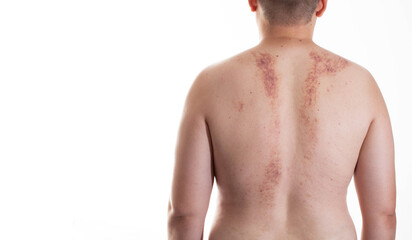 Redness and irritation on the skin of a man s back after a massage. Pimples and red spots with...