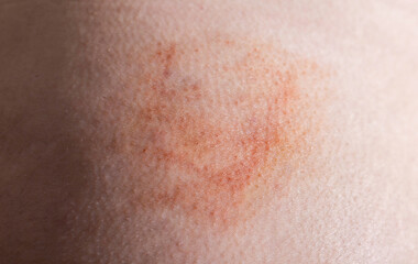 Bruise and subcutaneous lump on the patient s skin after injections. Post-injection infiltrates, close-up