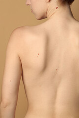 Naklejka premium Woman with moles on her skin against beige background, back view