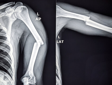X ray of upper arm showing fracture in the shaft of humerus bone 