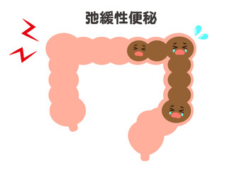 シンプルな弛緩性便秘のイラスト図解素材