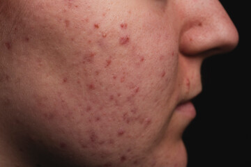 Pimple on face. Skin texture. Closeup acne skin. Treatment for skin. Problem skincare. Pimples,...
