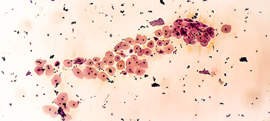 Paps smear: NILM with reactive cellular changes associated with inflammation. © Saiful52