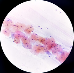 Paps smear: NILM with reactive cellular changes associated with inflammation.