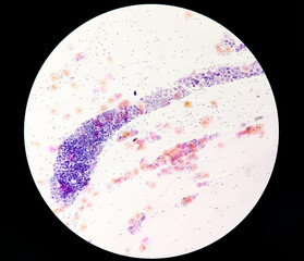 Paps smear: NILM with reactive cellular changes associated with inflammation.