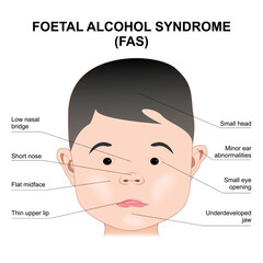 Foetal Alcohol Syndrome Child Illustration