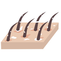 Dandruff hair Illustration. Hair follicle dandruff. Dermatology.