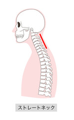 ストレートネックになった人体骨格イラスト