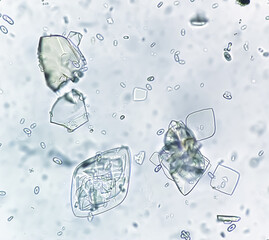 Uric acid crystals and calcium oxalate monohydrate under microscope