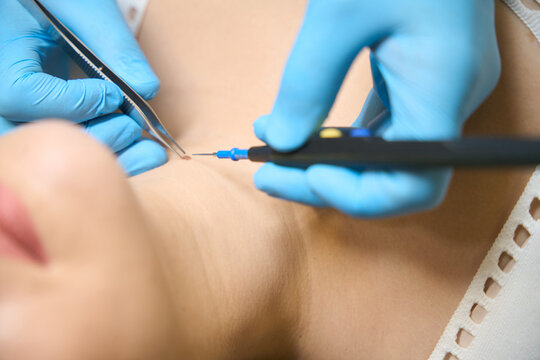 Dermatologist performing nevus removal on woman neck with electrocautery device