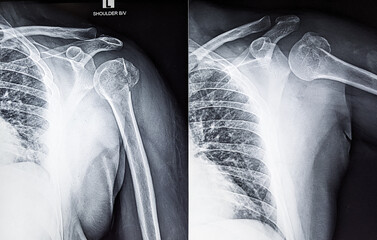 X ray film shows anterior dislocation of shoulder joint 