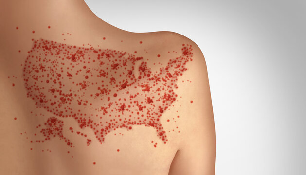 US Measles Outbreak and Increase in infection cases concept as a rising deadly outbreak disease and viral illness as a contagious chickenpox or a skin rash.