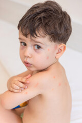 kid back with lot of insects bites,mosquito or fleas, red spots. lying baby boy on pillow and mother,woman hand applying gel,cream. child scratches his skin, feeling discomfort. summer issues